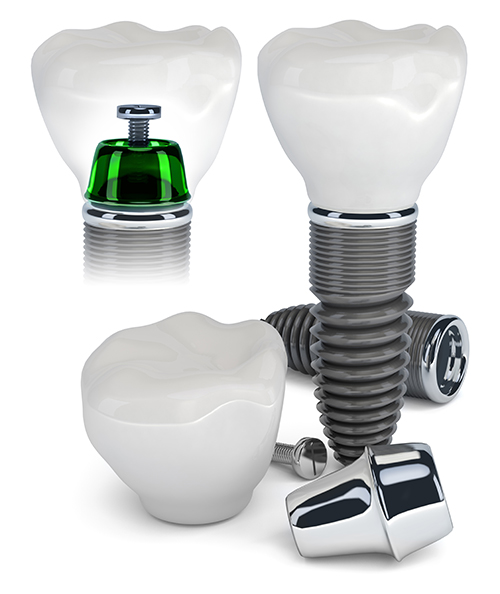 Dental Implants Admiral Heights